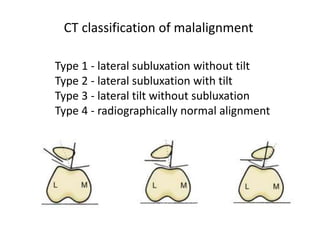 CT classification of malalignment
Type 1 - lateral subluxation without tilt
Type 2 - lateral subluxation with tilt
Type 3 - lateral tilt without subluxation
Type 4 - radiographically normal alignment
 
