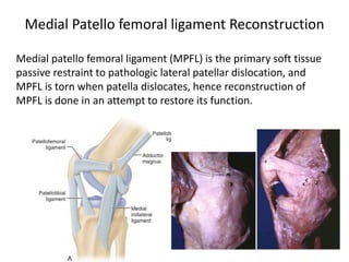 Medial patello femoral ligament (MPFL) is the primary soft tissue
passive restraint to pathologic lateral patellar dislocation, and
MPFL is torn when patella dislocates, hence reconstruction of
MPFL is done in an attempt to restore its function.
Medial Patello femoral ligament Reconstruction
 