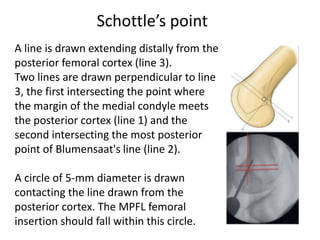 A line is drawn extending distally from the
posterior femoral cortex (line 3).
Two lines are drawn perpendicular to line
3, the first intersecting the point where
the margin of the medial condyle meets
the posterior cortex (line 1) and the
second intersecting the most posterior
point of Blumensaat's line (line 2).
A circle of 5-mm diameter is drawn
contacting the line drawn from the
posterior cortex. The MPFL femoral
insertion should fall within this circle.
Schottle’s point
 