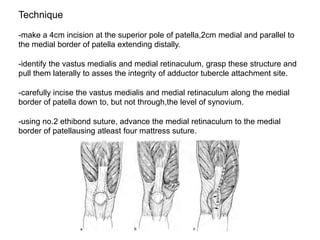 Technique
-make a 4cm incision at the superior pole of patella,2cm medial and parallel to
the medial border of patella extending distally.
-identify the vastus medialis and medial retinaculum, grasp these structure and
pull them laterally to asses the integrity of adductor tubercle attachment site.
-carefully incise the vastus medialis and medial retinaculum along the medial
border of patella down to, but not through,the level of synovium.
-using no.2 ethibond suture, advance the medial retinaculum to the medial
border of patellausing atleast four mattress suture.
 