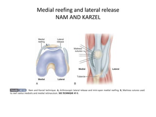 Medial reefing and lateral release
NAM AND KARZEL
 