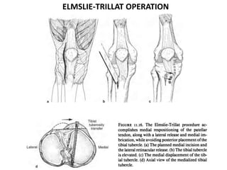 ELMSLIE-TRILLAT OPERATION
 