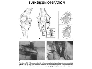 FULKERSON OPERATION
 