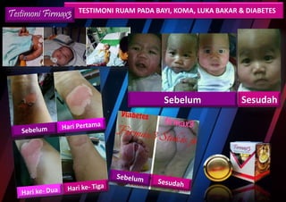 TESTIMONI RUAM PADA BAYI, KOMA, LUKA BAKAR & DIABETESTestimoni Firmax3
Sebelum Sesudah
 