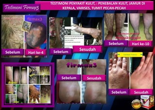 TESTIMONI PENYAKIT KULIT, : PENEBALAN KULIT, JAMUR DI
KEPALA, VARISES, TUMIT PECAH-PECAHTestimoni Firmax3
Hari ke-4Sebelum
SesudahSebelum
Hari ke-10Sebelum
SesudahSebelum
SesudahSebelum
 