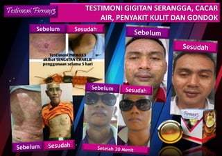 TESTIMONI GIGITAN SERANGGA, CACAR
AIR, PENYAKIT KULIT DAN GONDOK
Testimoni Firmax3
Sebelum Sesudah
 