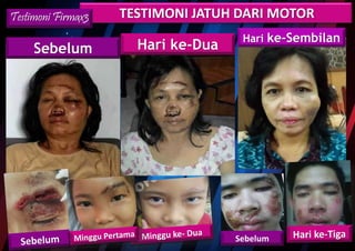 TESTIMONI JATUH DARI MOTORTestimoni Firmax3
Sebelum Hari ke-Dua
Hari ke-Sembilan
Sebelum
 