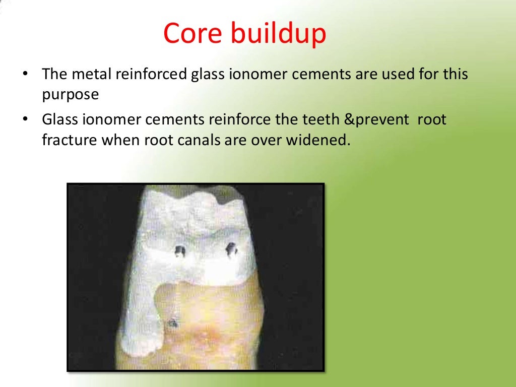 GLASS IONOMER CEMENT AND ITS RECENT ADVANCES by Dr. JAGADEESH KODITY…