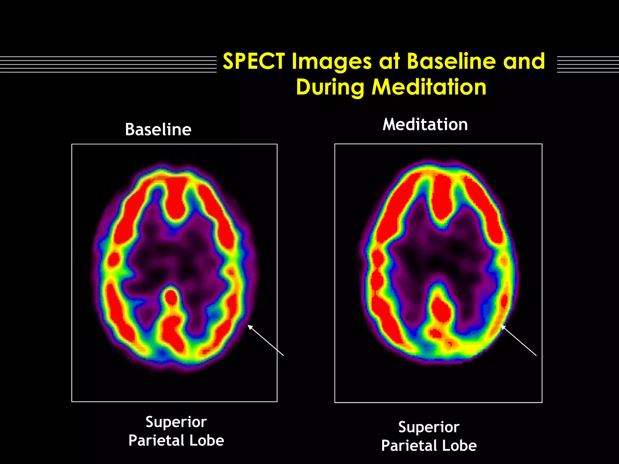 SPECT Images at Baseline and
During Meditation
Baseline

Meditation

Superior
Parietal Lobe

Superior
Parietal Lobe

 