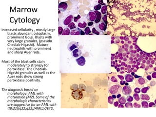 MarrowCytologyincreased cellularity , mostly large blasts abundant cytoplasm, prominent Golgi. Blasts with very large granules, (pseudo Chediak-Higashi).  Mature neutrophils with prominent and sharp Auer rods.  Most of the blast cells stain moderately to strongly for peroxidase. The Chediak-Higashi granules as well as the Auer rods show strong peroxidase positivity. The diagnosis based on morphology: AML with maturation (M2). Some of the morphologic characteristics are suggestive for an AML with t(8;21)(q22;q22)/AML1//ETO.