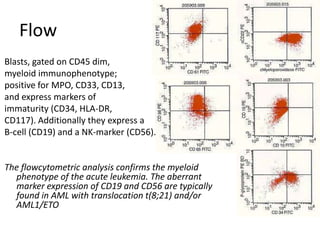 FlowBlasts, gated on CD45 dim, myeloid immunophenotype; positive for MPO, CD33, CD13, and express markers of immaturity (CD34, HLA-DR, CD117). Additionally they express a B-cell (CD19) and a NK-marker (CD56). The flowcytometric analysis confirms the myeloid phenotype of the acute leukemia. The aberrant marker expression of CD19 and CD56 are typically found in AML with translocation t(8;21) and/or AML1/ETO