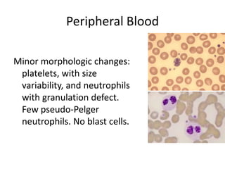 Peripheral Blood Minor morphologic changes: platelets, with size variability, and neutrophils with granulation defect. Few pseudo-Pelgerneutrophils. No blast cells. 