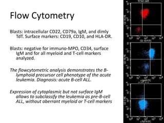 Flow CytometryBlasts: intracellular CD22, CD79a, IgM, and dimly TdT. Surface markers: CD19, CD10, and HLA-DR. Blasts:negative for immuno-MPO, CD34, surface IgM and for all myeloid and T-cell markers analyzed. The flowcytometric analysis demonstrates the B-lymphoid precursor cell phenotype of the acute leukemia. Diagnosis: acute B-cell ALL.  Expression of cytoplasmic but not surface IgM allows to subclassify the leukemia as pre-B-cell ALL, without aberrant myeloid or T-cell markers 