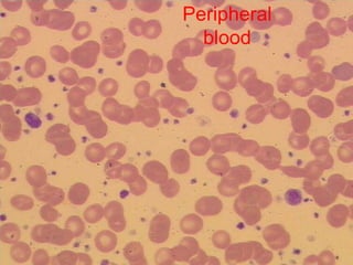 Confirmation of the B-CLLComplete ImmunophenotypeLymphocytes positive forCD19, CD20dim, CD23, CD5, kappa, sIgM dimLymphocytes negative for:FMC-7, CD79b, CD103, CD10