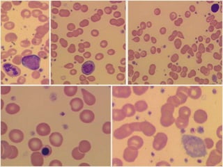 How to define management strategyYoung patient with B-CLLRai 0, Binet AConsiderations for management strategyAge of the patientAge - not an independent risk factor in CLLYounger patients are more likely to die from CLLStage of the disease: early stage is due to early stage with undefined prognosis or good prognosis CLL – smoldering diseaseWe need more information