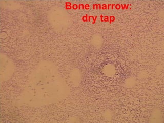 Genetics -> Prognosisinterphase  FISHGood prognosisIsolated del 13q14IntermediateTrisomy 12Normal karyotypePoor prognosisdel 11qdel17pdel 11q