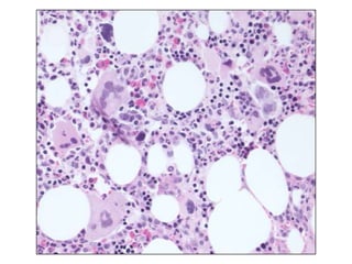 Biological surrogate markers for mutational  statusMutational status not routinely availableCD38 expression on B-cellsPoor  prognosis: positive ( 30%)No good correlation with mutational statusZAP70 expression on B-cellsPoor prognosis: positive (>20%)Better correlation  