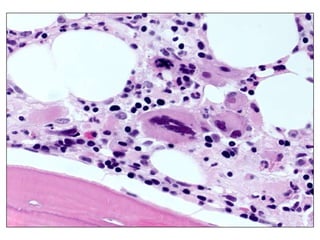 Interpretation of the global situation and next stepsEarly stage, high risk B-CLL in a young patientCLL asymptomaticRai I / Binet A stage, lymphocyte countFISH del(11q); ZAP-70 positive, CD38 positiveWatch and wait as long as asymptomaticIn particular cases option of experimental therapyHLA-typing of the familyif no sibling donor available, consider unrelated donorClose follow-up of the patientThree monthly