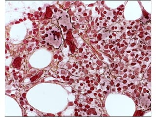 Take home messageMore complete diagnosic workup is needed, when therapeutic intervention is an optionDistinction between different lymphoid neoplasmsDetermination of prognostic factorsNew biological prognostic markers do not directly determinate the time of treatmentThey may have an impact on the long term treatment strategyClinical staging still plays a essential role 