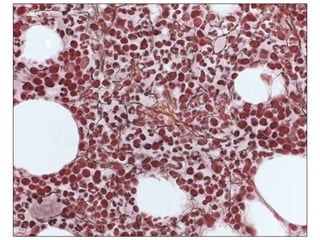 Case 6History/ Clinicalfindings53 year old, female Presenting a transient ischemic attack (TIA) BrachiofacialhemiparesisRisk factors, dyslipidemia, and cigarette smokingWeight loss of 7kg with 5 monthsDiscrete splenomegaly