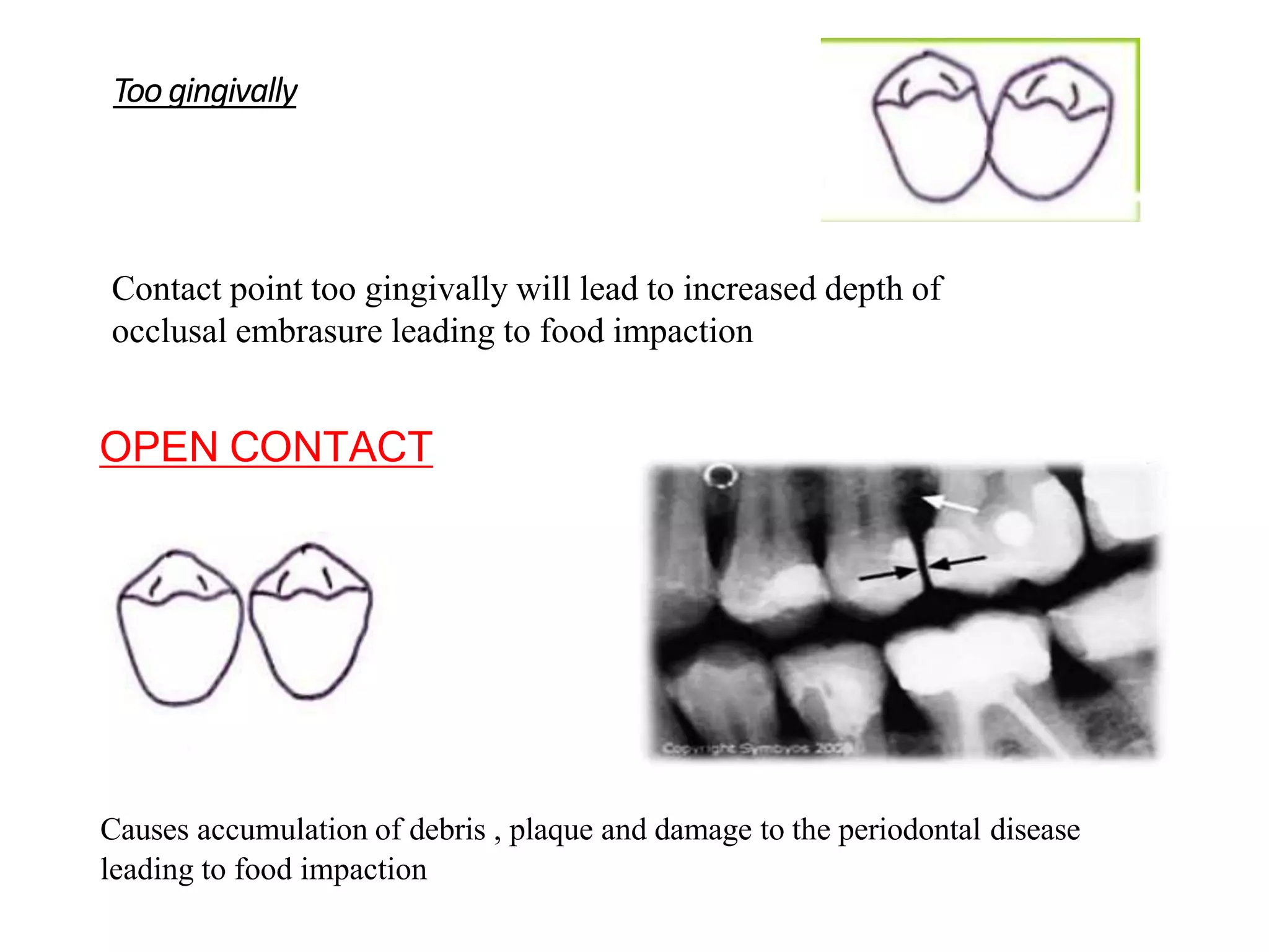 CONTACTS AND  CONTOURS IN DENTISTRY