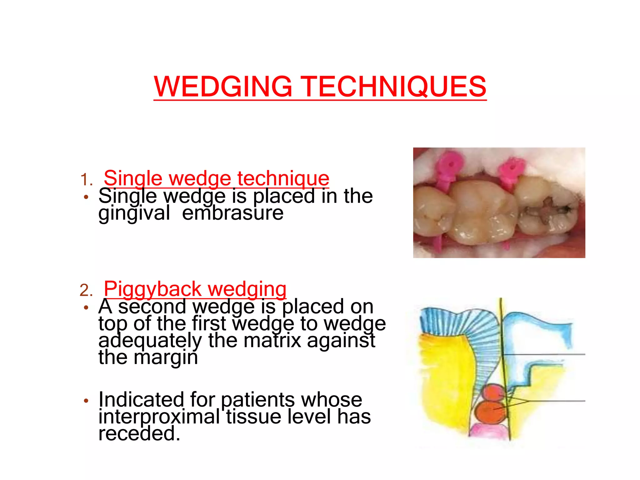 CONTACTS AND  CONTOURS IN DENTISTRY