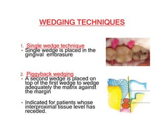 CONTACTS AND  CONTOURS IN DENTISTRY
