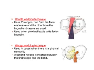 CONTACTS AND  CONTOURS IN DENTISTRY