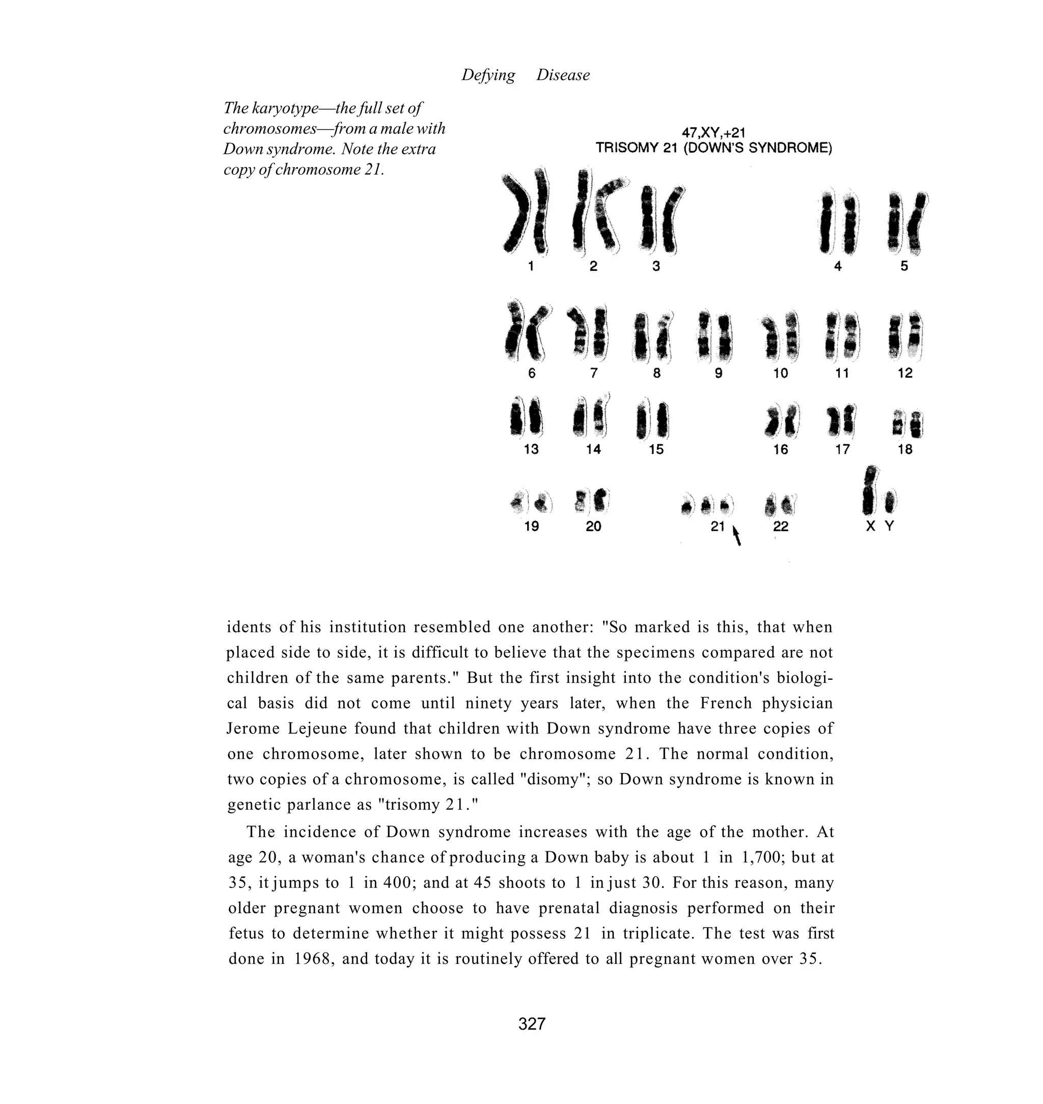 Defying    Disease
The karyotype—the full set of
chromosomes—from a male with
Down syndrome. Note the extra
copy of chromosome 21.




idents of his institution resembled one another: "So marked is this, that when
placed side to side, it is difficult to believe that the specimens compared are not
children of the same parents." But the first insight into the condition's biologi-
cal basis did not come until ninety years later, when the French physician
Jerome Lejeune found that children with Down syndrome have three copies of
one chromosome, later shown to be chromosome 21. The normal condition,
two copies of a chromosome, is called "disomy"; so Down syndrome is known in
genetic parlance as "trisomy 21."
   The incidence of Down syndrome increases with the age of the mother. At
age 20, a woman's chance of producing a Down baby is about 1 in 1,700; but at
35, it jumps to 1 in 400; and at 45 shoots to 1 in just 30. For this reason, many
older pregnant women choose to have prenatal diagnosis performed on their
fetus to determine whether it might possess 21 in triplicate. The test was first
done in 1968, and today it is routinely offered to all pregnant women over 35.


                                          327
 