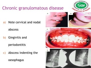 Chronic granulomatous disease
a) Note cervical and nodal
abscess
b) Gingivitis and
periodontitis
c) Abscess indenting the
oesophagus
 