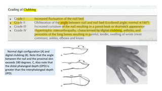 Clubbing Pathophysiology Notes Comprehensive Assessment of Pulmonary System and Respiratory Diseases ...