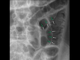 Walnut On Radiograph Interpreting chest & abdominal radiographs - Mr Jamie Dunn | PPT