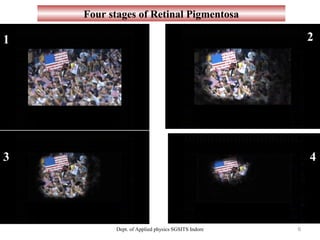 1
43
2
Four stages of Retinal Pigmentosa
Dept. of Applied physics SGSITS Indore 6
 
