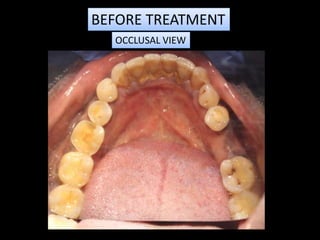 BEFORE TREATMENT
OCCLUSAL VIEW
 