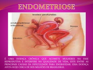 É UMA DOENÇA CRÔNICA QUE ACOMETE MULHERES NA FASE 
REPRODUTIVA E INTERFERE NA QUALIDADE DE VIDA, ESTÁ ENTRE AS 
PRINCIPAIS CAUSAS DA DIFICULDADE PARA ENGRAVIDAR. ESSA DOENÇA 
AFETA HOJE CERCA DE SEIS MILHÕES DE BRASILEIRAS. 
 