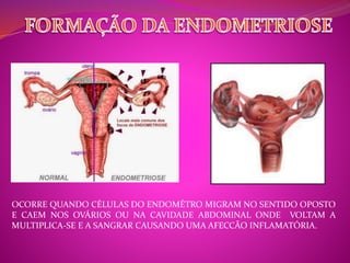 OCORRE QUANDO CÉLULAS DO ENDOMÉTRO MIGRAM NO SENTIDO OPOSTO 
E CAEM NOS OVÁRIOS OU NA CAVIDADE ABDOMINAL ONDE VOLTAM A 
MULTIPLICA-SE E A SANGRAR CAUSANDO UMA AFECCÃO INFLAMATÓRIA. 
 
