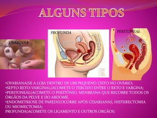 OVARIANA 
PROFUNDA PERITONEAL 
•OVARIANA(SE A LOJA DENTRO DE UM PEQUENO CISTO NO OVÁRIO; 
•SEPTO RETO-VARGINAL(ACOMETE O TERCIDO ENTRE O RETO E VARGINA; 
•PERITONEAL(ACOMETE O PERITÔNIO, MENBRANA QUE RECOBRE TODOS OS 
ÓRGÃOS DA PELVE E DO ABDOME. 
•ENDOMETRIOSE DE PAREDE(OCORRE APÓS CESARIANAS, HISTERECTOMIA 
OU MIOMECTOMIA; 
PROFUNDA(ACOMETE OS LIGAMENTO E OUTROS ORGÃOS; 
 
