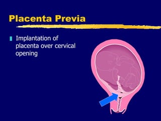 Placenta Previa  <ul><li>Implantation of placenta over cervical opening </li></ul>