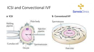 ICSI and Convectional IVF
 