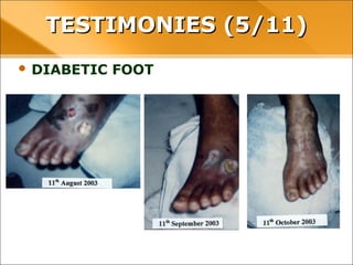 • DIABETIC FOOT
TESTIMONIES (5/11)TESTIMONIES (5/11)
 
