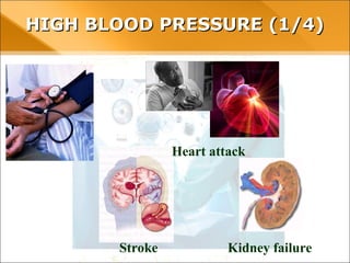 Heart attack
Stroke Kidney failure
HIGH BLOOD PRESSURE (1/4)HIGH BLOOD PRESSURE (1/4)
 