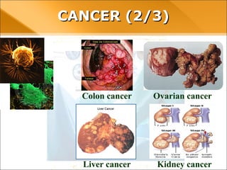 CANCER (2/3)
Colon cancer Ovarian cancer
Liver cancer Kidney cancer
 
