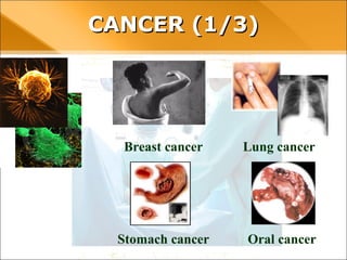 CANCER (1/3)
Breast cancer Lung cancer
Stomach cancer Oral cancer
 