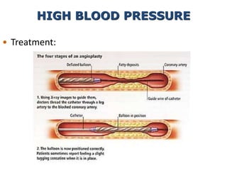 • Treatment:
HIGH BLOOD PRESSURE
 