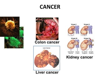 CANCER
Colon cancer
Liver cancer
Kidney cancer
 