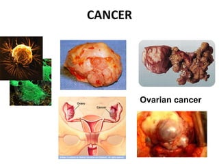 CANCER
Ovarian cancer
 