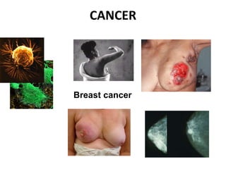 CANCER
Breast cancer
 