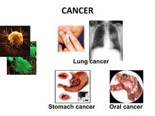 CANCER
Stomach cancer Oral cancer
Lung cancer
 