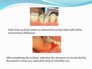 Half of the occlusal surface is reduced first so that other half will be
maintained as Refarance.
After completing the occlusal reduction the clearance can be checked by
the patient to close on a 2mm thick strip of red utility wax.
 