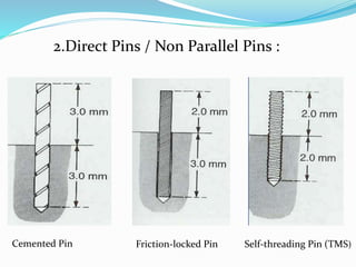 2.Direct Pins / Non Parallel Pins :
Cemented Pin Friction-locked Pin Self-threading Pin (TMS)
 